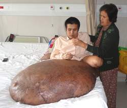 Nguyen Duy Hai akirwaye ikibyimba
